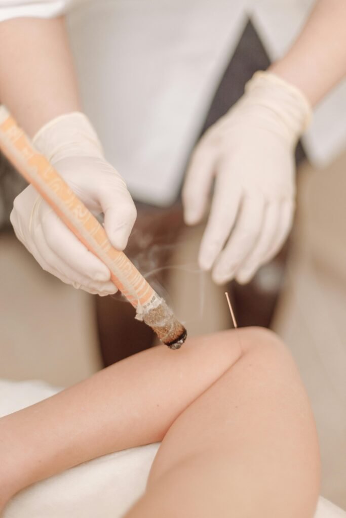 Close-up of an acupuncture treatment with moxibustion, showcasing therapeutic technique.