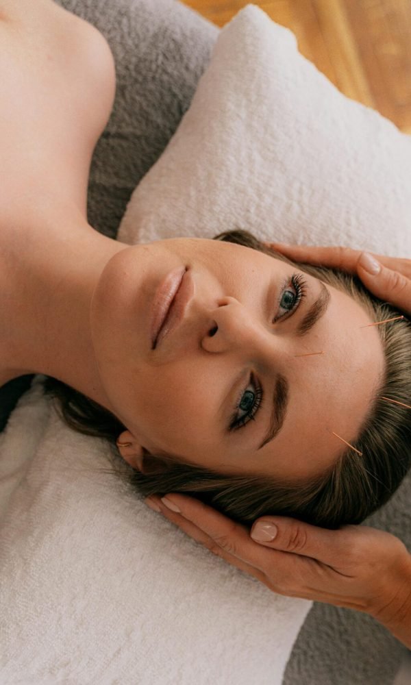 Woman receiving acupuncture therapy in a serene, indoor setting for wellness enhancement.